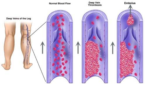 Verschillende bloedvaten om trombose en een embolie aan te geven